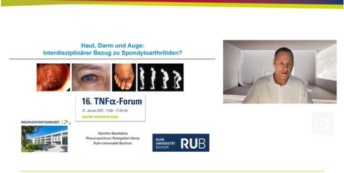 Im Video: Extramuskuloskelettale Manifestationen bei Spondyloarthritiden (SpA)