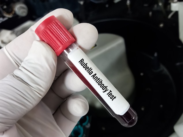 Blutprobe mit der Aufschrift „Rubella Antibody Test“